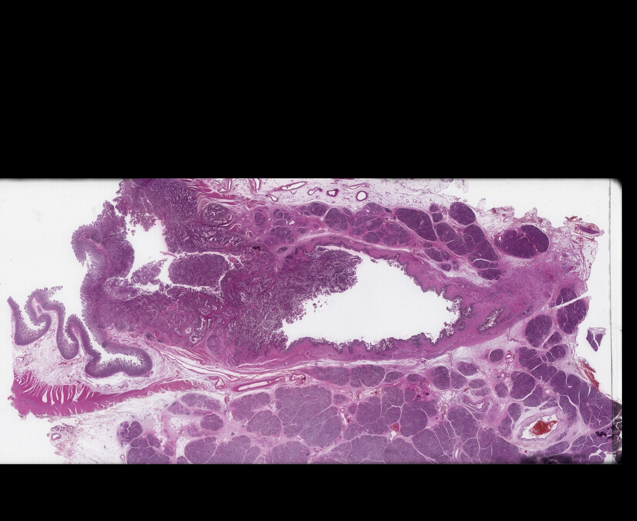 Ampulla yerleşimli intraampüller papiller neoplazi zemininde gelişmiş
adenokarsinomun megalamda alınan örneğinin dijitalleştirilmiş hali.
Birkaç lamda ancak incelenebilecek görüntünün megalam tarayıcısı ile
alınan bu görüntüsü sayesinde hem tümörün yayılımı daha kolay
anlaşılabiliyor, hem radyolojik korelasyon daha kolay yapılabiliyor hem
de tümör biyolojisini anlamak daha da
kolaylaşıyor.